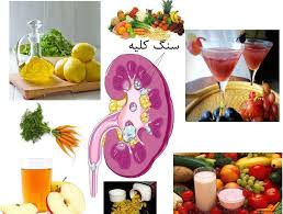 ۷ اقدام تغذیه‌ای کلیدی برای پیشگیری از سنگ کلیه / هشدار متخصصان درباره ضرورت توجه به برچسب مواد غذایی